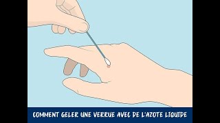 Comment geler une verrue avec de lazote liquide [upl. by Eolande]