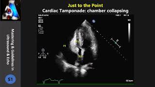 cardiac tamponadecollapsing chamber [upl. by Bohman]