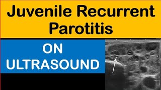 Juvenile Recurrent Parotitis On Ultrasound [upl. by Armyn]