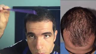 4 MESES Pós Implante Transplante CAPILAR  Resultado 120 dias ANTES e DEPOIS  FUT ou FUE [upl. by Iphigeniah336]