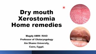 Home remedies for Dry mouth Xerostomia [upl. by Nestor]