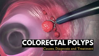 Colorectal Polyps Causes Signs and Symptoms Diagnosis and Treatment [upl. by Ruddie]