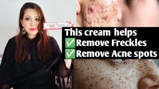 How to use Freckles removal cream to remove Pimple marks brown spots freckle melasma  Mixed Bag [upl. by Auhsaj]