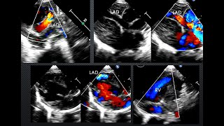 Echocardiography of coronary cameral coronary pulmonary artery and coronary pulmonary vein fistula [upl. by Kirkwood]