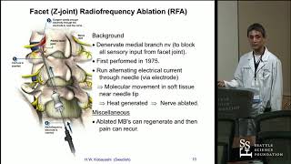 Radiofrequency Ablation RFA for Lumbar Facet Arthropathy Hisashi Wesley Kobayashi MD [upl. by Parrisch]