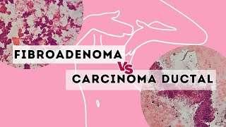 Fibroadenoma versus carcinoma ductal [upl. by Sabec]