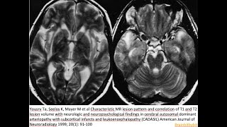 70 CADASIL Notch3 arteriopathy pericyt blood brain barrier anterior temporal pole stroke [upl. by Yenruogis]