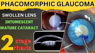 Phacomorphic glaucoma amp Intumescent mature cataract with swollen lens 2stage rhexis  Dr Deepak M [upl. by Atrice]