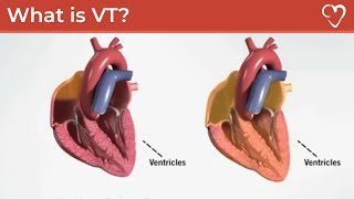 What is Ventricular Tachycardia VT [upl. by Anez851]