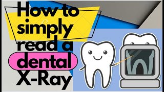 How To Understand Your Dental Xrays  How to Read Dental XRays Radiographic Interpretation [upl. by Anivas]