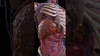 Cirrhosis Liver Under Siege 3dmodel meded anatomy [upl. by Yate168]