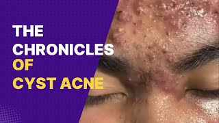 quotBanish Acne Proven Treatment Tips for Clear Skinquot cystic acne treatment cystic acne removal [upl. by Yleen638]