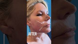 PDO Thread Lift Before and After PCH MedSpa Newport Beach [upl. by Oznecniv]