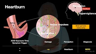 GERD  Understanding Heartburn [upl. by Andersen]