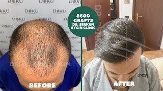 Clinica DrSerkan Aygin 8600 grafts FUEDHI in 2 chirurgie [upl. by Herrera]