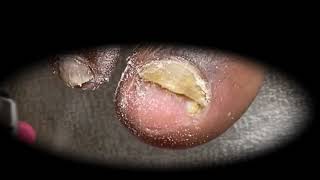 Ingrown Toenails Treatment Satisfying Pedicure Manicure 17 [upl. by Mulford]