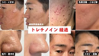 【完全版】トレチノイン経過まとめ！効果的な使い方・おすすめの塗り方【毛穴・ニキビ・シミ・ニキビ跡】 [upl. by Jonette58]