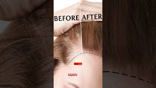 Minoxidil 1052 Mintop  Hair lossHair ReGrowBaldness Doctor Meds Uses In HindiampEngSub [upl. by Lledniw]