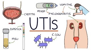 Understanding Urinary Tract Infections [upl. by Eecrad]