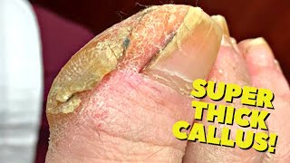 THICK Cracked Callus Trimming Satisfying [upl. by Ahsienom]