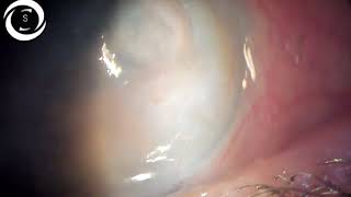 Amniotic membrane grafting for bullous keratopathy [upl. by Allerym580]