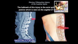 Flexion Distraction Injury Of The lumbar Spine  Everything You Need To Know  Dr Nabil Ebraheim [upl. by Ettenim]