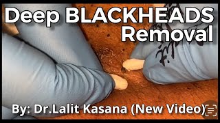 Deep Old Blackhead Removal with Cotton Buds amp Extractor by DrLalit Kasana [upl. by Neelsaj]