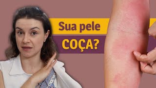 5 dicas de como cuidar de uma pele com DERMATITE ATÓPICA [upl. by Novad822]