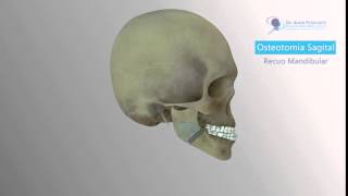 Osteotomia Sagital Recuo Mandibular  Cirurgia Ortognática [upl. by Quintessa344]