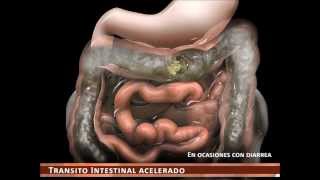 sindrome de intestino irritable [upl. by Oilejor501]