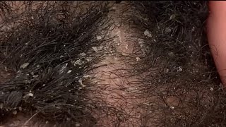 Dandruff Picking and Scratching  Flaky Eczema Scalp extreme close up ASMR [upl. by Adnahcal]