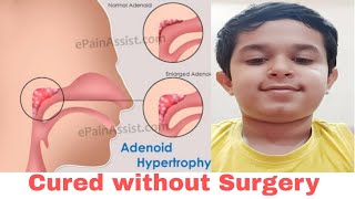 Enlarged Adenoids Hypertrophy Treated without Surgery Operation। Home Remedies । Naturopathy। ENT [upl. by Wahl]