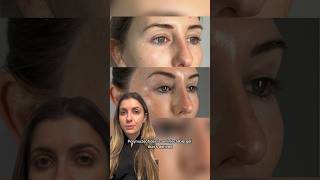 Polynucleotides for undereye rejuvenation  Dr MediSpa [upl. by Esorbma820]