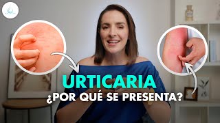 🔴 URTICARIA  Que es Sintomas y tratamiento drapilarochoa  Dermatologa [upl. by Huebner]