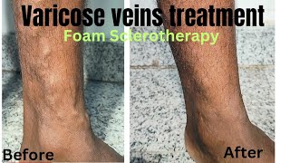 Foam sclerotherapy treatment for varicose veins Miracle of varicose veins treatment varicosevein [upl. by Nuahs]