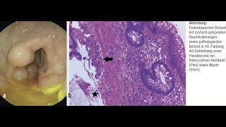 Colitis cystica profunda [upl. by Graner]