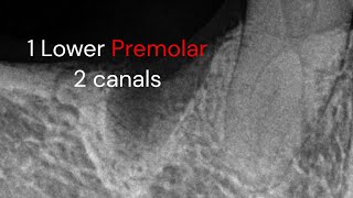 Endodontic treatment Lower premolar 2 canals [upl. by Liew]