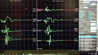 Neuromonitoring MEP Changes  TIVA to GAS  Motor Evoked Potential changes [upl. by Nnaillij]