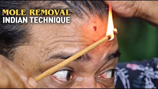 Mole Removal by Asim Barber  How to Remove Mole with Fire  ASMR [upl. by Pish433]