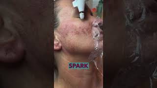 MindBlowing Fibroblast Treatment [upl. by Jamey]