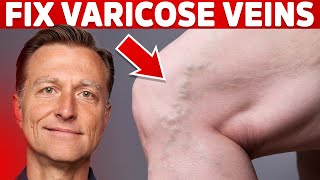 How to Treat Varicose Veins Naturally – Dr Berg [upl. by Yllop]