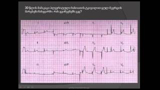 ეკგ ნაადრევი რეპოლარიზაციის სინდრომი ST სეგმენტის მაღალი გამოსვლის სინდრომი [upl. by Myrna]