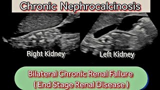 Chronic Renal Disease CKD  Nephrocalcinosis Ultrasound  EndStage Kidneys [upl. by Freed631]