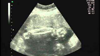 Ultrasound scan at 33 week pregnancy [upl. by Allac8]