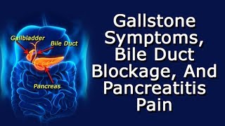 Gallstone Symptoms Bile Duct Blockage And Pancreatitis Pain [upl. by Gamber]