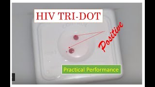 HIV Rapid antibody testReactive HIV tridot Positive HIV blood test Positive [upl. by Torrence999]