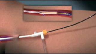 Animation of Endovenous Radiofrequency Ablation of Varicose Vein [upl. by Sivek]