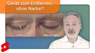 Fibrome ohne Narbe und Betäubung entfernen Shorts [upl. by Fancy]