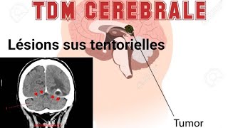 SCANNER CEREBRAL  Lésions sus tentorielles droites séquellaires [upl. by Penny]