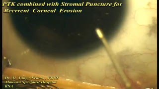 PTK with stromal Puncture for RCE [upl. by Seiuqram]